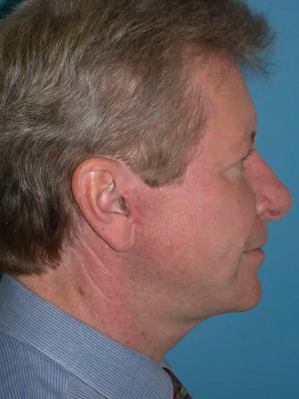 Facelift Before & After Gallery - Patient 4757011 - Image 4