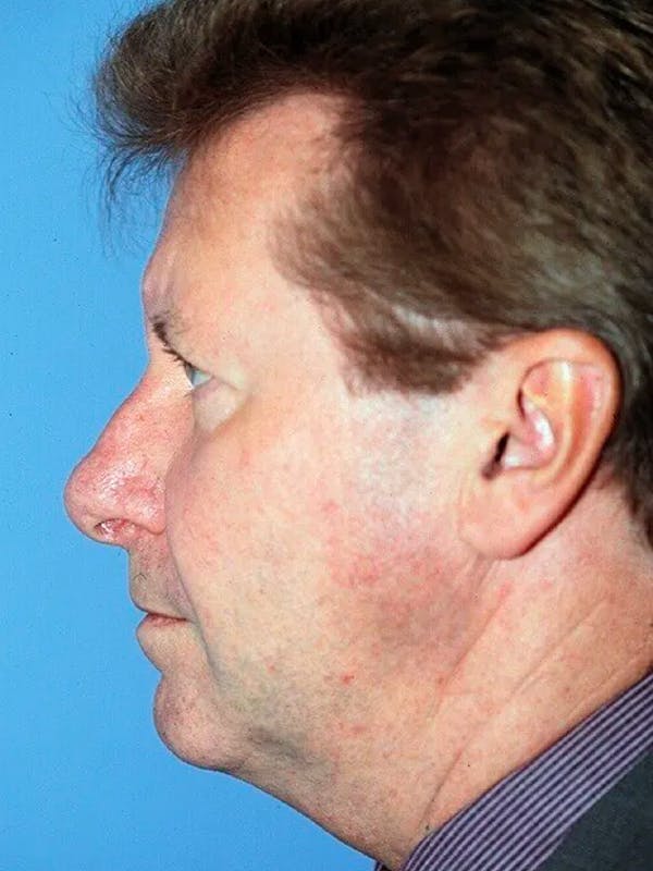 Facelift Gallery Before & After Gallery - Patient 4757011 - Image 5