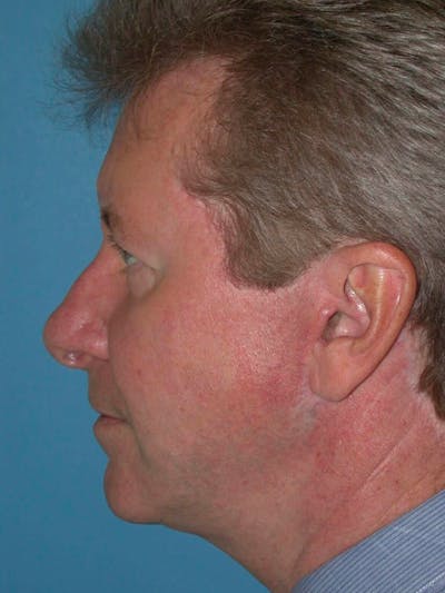 Facelift Before & After Gallery - Patient 4757011 - Image 6