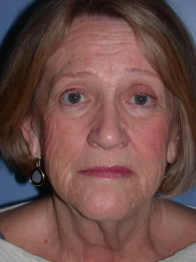 Facelift Before & After Gallery - Patient 4756954 - Image 1