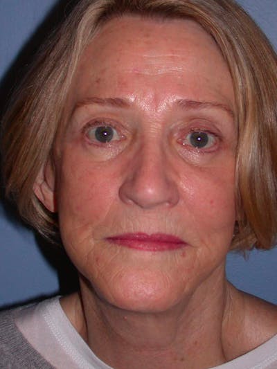 Facelift Before & After Gallery - Patient 4756954 - Image 2