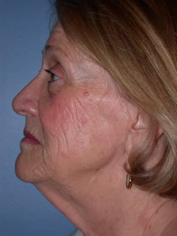 Facelift Before & After Gallery - Patient 4756954 - Image 3