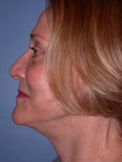 Facelift Gallery Before & After Gallery - Patient 4756954 - Image 4