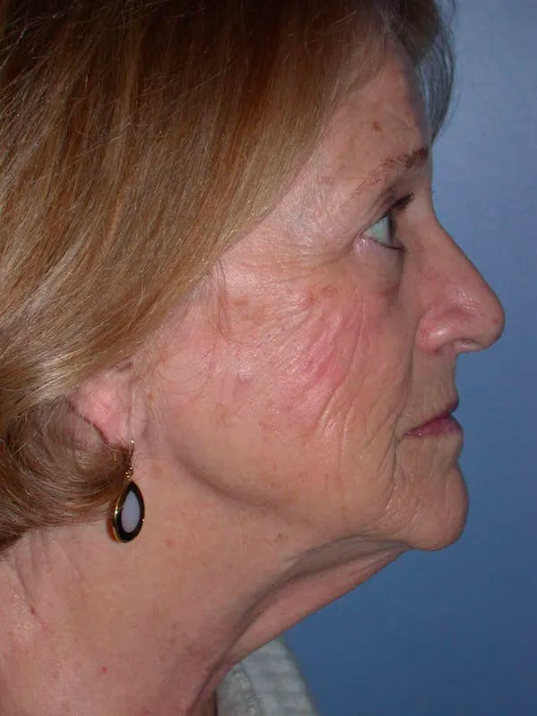 Facelift Before & After Gallery - Patient 4756954 - Image 5