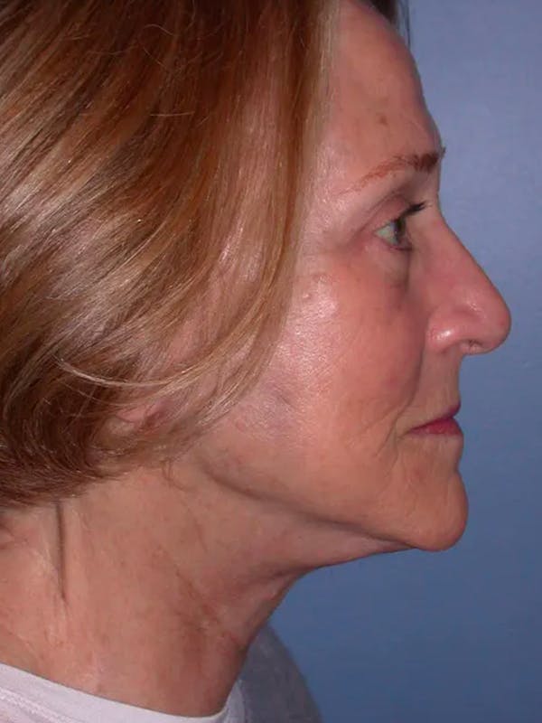 Facelift Gallery Before & After Gallery - Patient 4756954 - Image 6