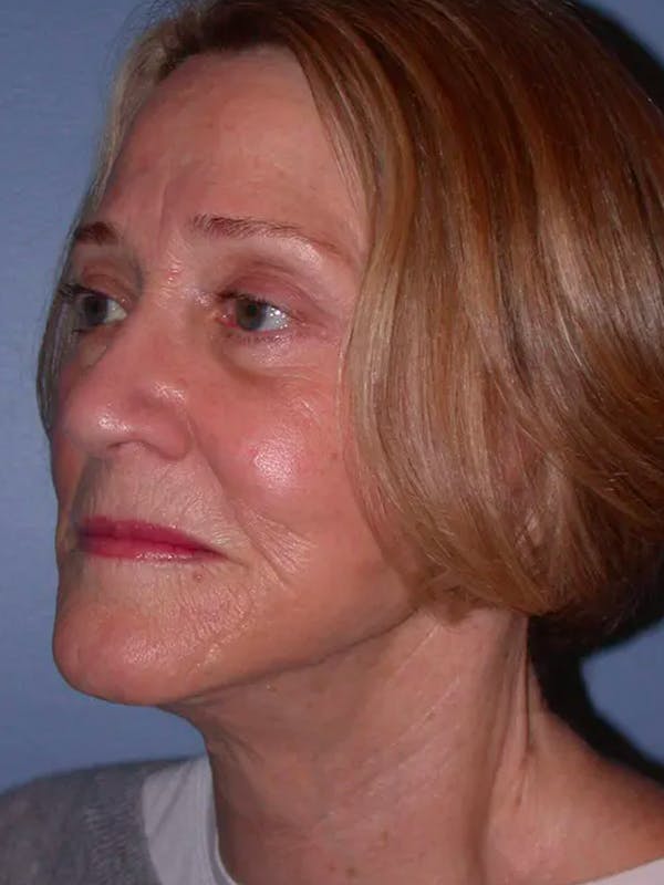 Facelift Gallery Before & After Gallery - Patient 4756954 - Image 8