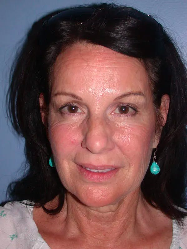 Facelift Before & After Gallery - Patient 4756963 - Image 1