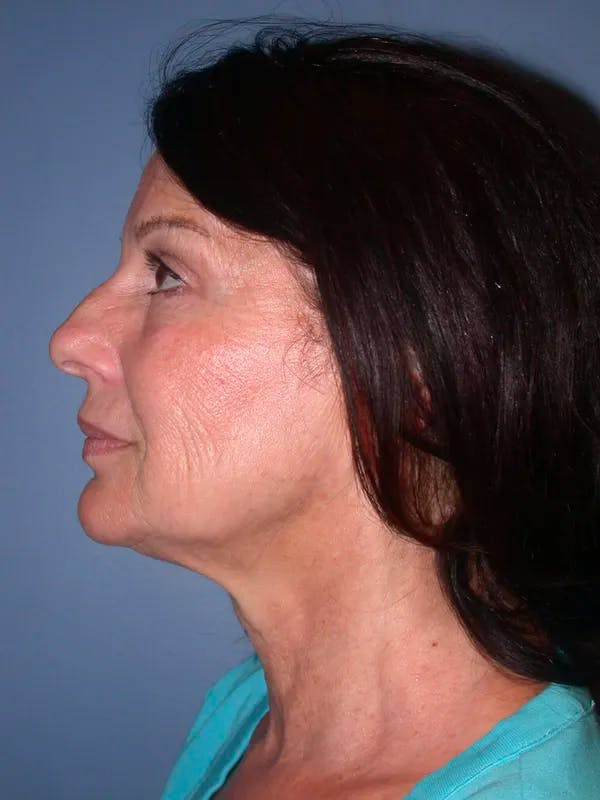 Facelift Before & After Gallery - Patient 4756963 - Image 3