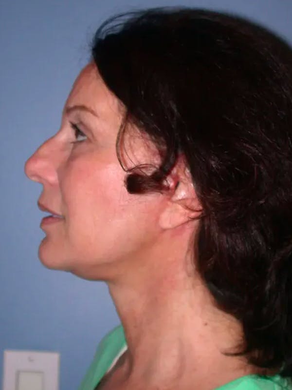 Facelift Before & After Gallery - Patient 4756963 - Image 4