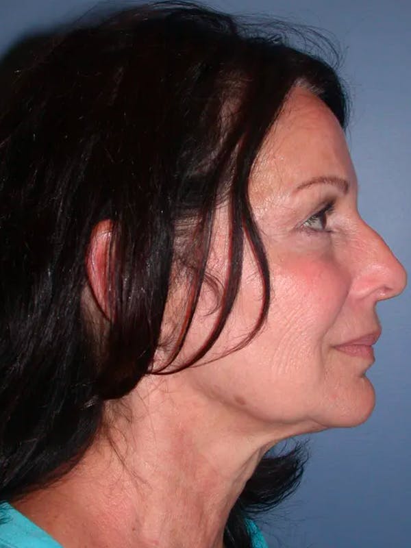 Facelift Before & After Gallery - Patient 4756963 - Image 5