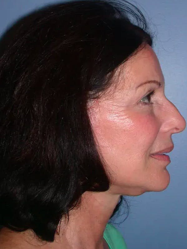 Facelift Before & After Gallery - Patient 4756963 - Image 6