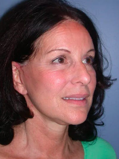 Facelift Before & After Gallery - Patient 4756963 - Image 8