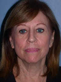 Facelift Before & After Gallery - Patient 4756989 - Image 1