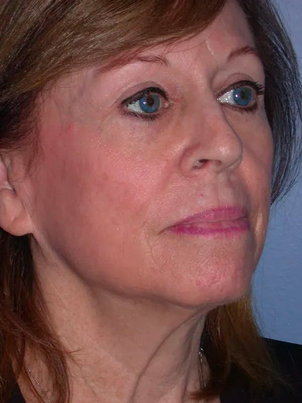 Facelift Before & After Gallery - Patient 4756989 - Image 3