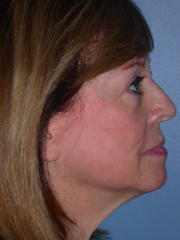 Facelift Before & After Gallery - Patient 4756989 - Image 5