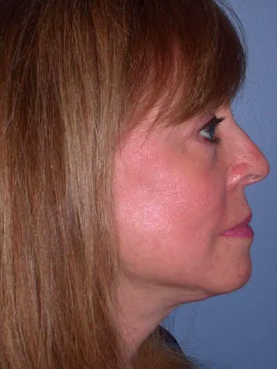 Facelift Gallery Before & After Gallery - Patient 4756989 - Image 6