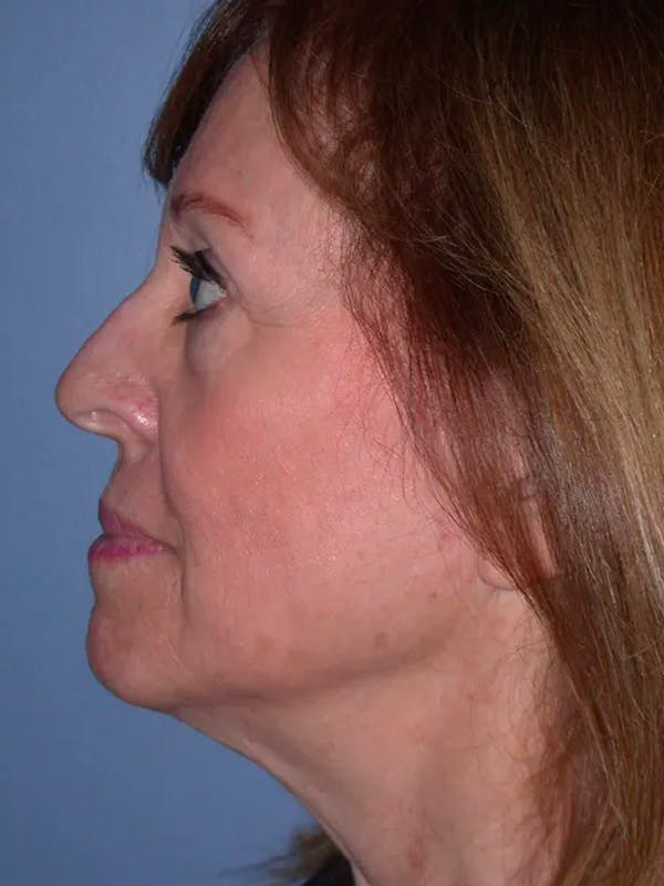 Facelift Before & After Gallery - Patient 4756989 - Image 7