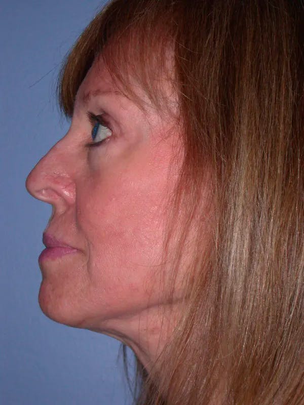 Facelift Before & After Gallery - Patient 4756989 - Image 8