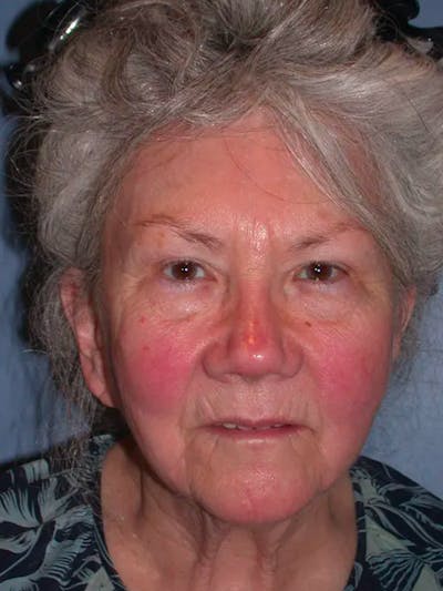 Facelift Before & After Gallery - Patient 4757002 - Image 1