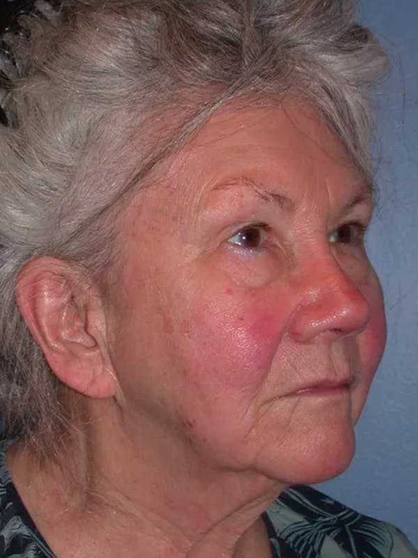 Facelift Before & After Gallery - Patient 4757002 - Image 3