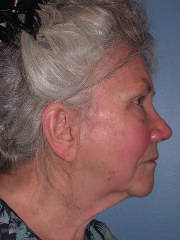 Facelift Gallery Before & After Gallery - Patient 4757002 - Image 5