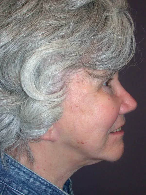 Facelift Before & After Gallery - Patient 4757002 - Image 6