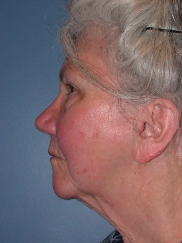 Facelift Gallery Before & After Gallery - Patient 4757002 - Image 7
