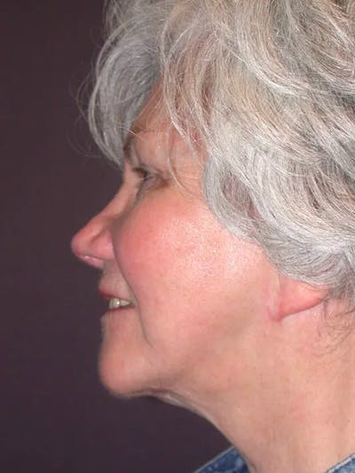 Facelift Before & After Gallery - Patient 4757002 - Image 8