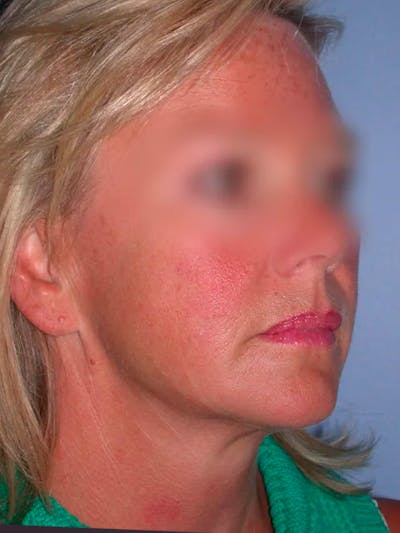 Facelift Gallery Before & After Gallery - Patient 4757005 - Image 1