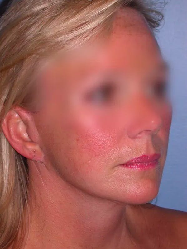 Facelift Before & After Gallery - Patient 4757005 - Image 2