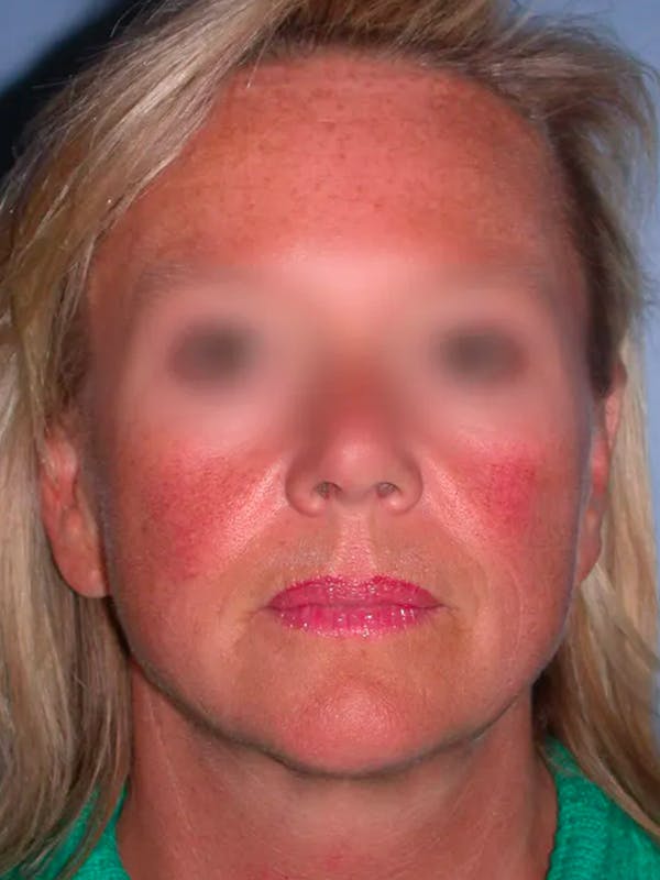 Facelift Gallery Before & After Gallery - Patient 4757005 - Image 3