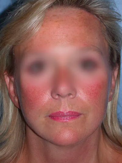 Facelift Gallery Before & After Gallery - Patient 4757005 - Image 4