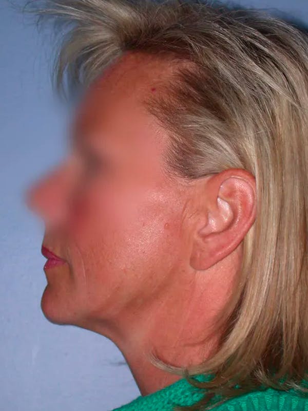 Facelift Gallery Before & After Gallery - Patient 4757005 - Image 5