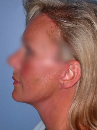 Facelift Gallery Before & After Gallery - Patient 4757005 - Image 6