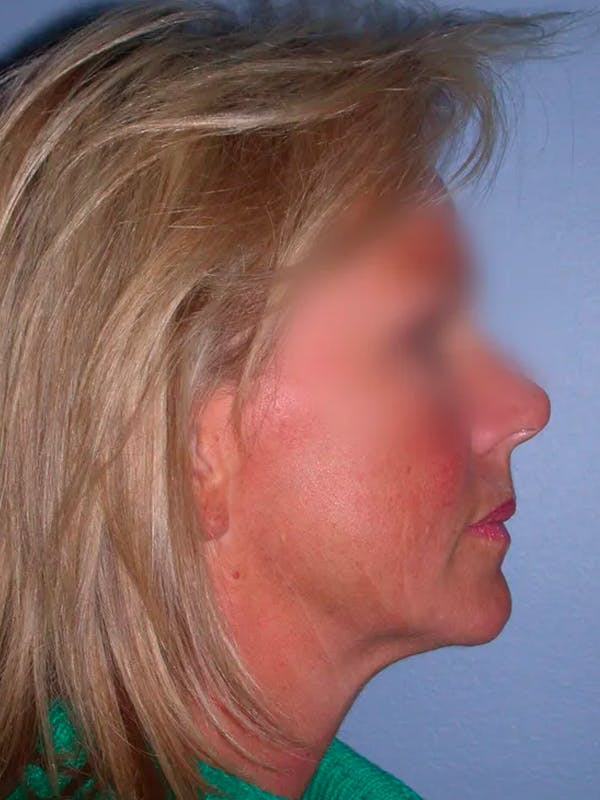 Facelift Gallery Before & After Gallery - Patient 4757005 - Image 7