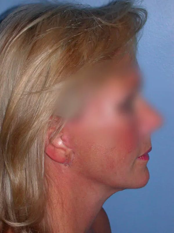 Facelift Before & After Gallery - Patient 4757005 - Image 8