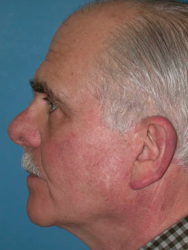 Male Facial Procedures Gallery - Patient 140819941 - Image 4