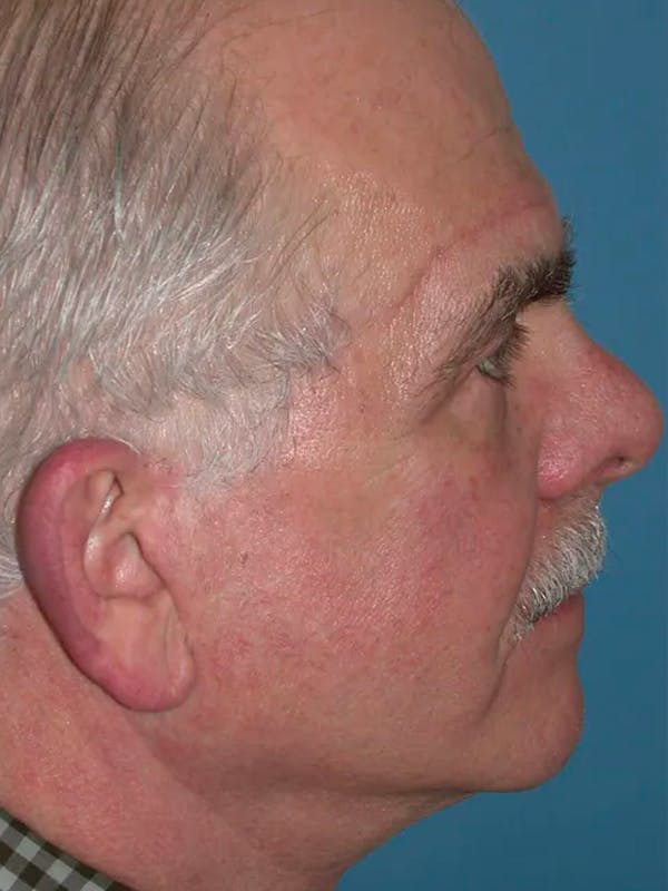 Male Facial Procedures Gallery - Patient 140819941 - Image 6