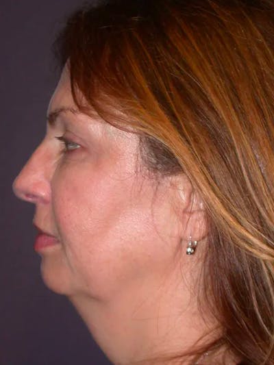 Neck Lift Gallery Before & After Gallery - Patient 4757142 - Image 1