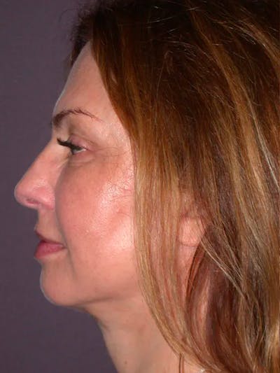 Neck Lift Gallery Before & After Gallery - Patient 4757142 - Image 2