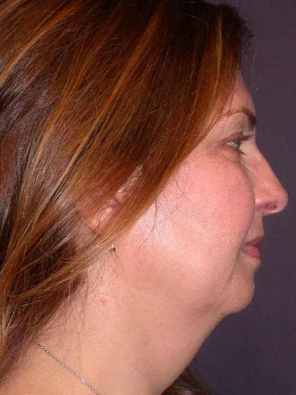 Neck Lift Gallery Before & After Gallery - Patient 4757142 - Image 3