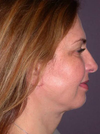 Neck Lift Gallery Before & After Gallery - Patient 4757142 - Image 4