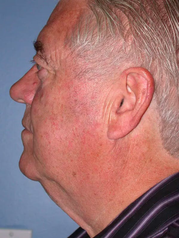 Neck Lift Before & After Gallery - Patient 4757172 - Image 3