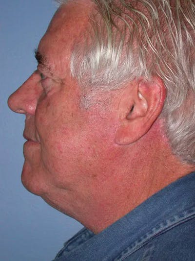 Neck Lift Gallery Before & After Gallery - Patient 4757172 - Image 4