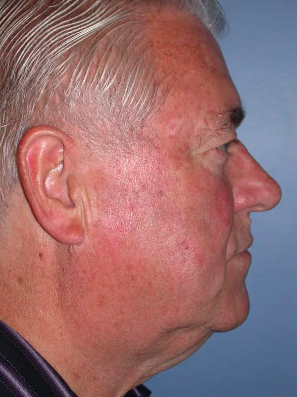 Neck Lift Before & After Gallery - Patient 4757172 - Image 5