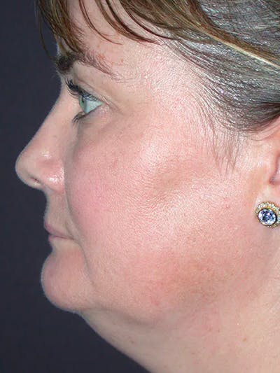 Neck Lift Gallery Before & After Gallery - Patient 40633466 - Image 1