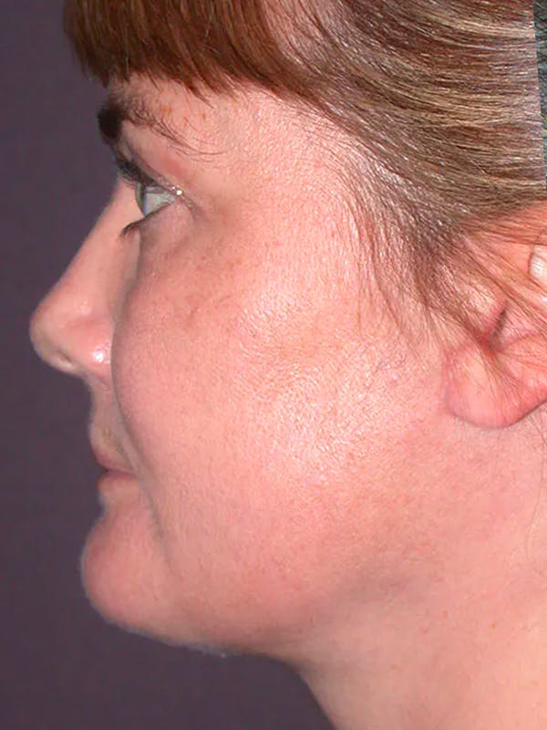 Neck Lift Before & After Gallery - Patient 40633466 - Image 2