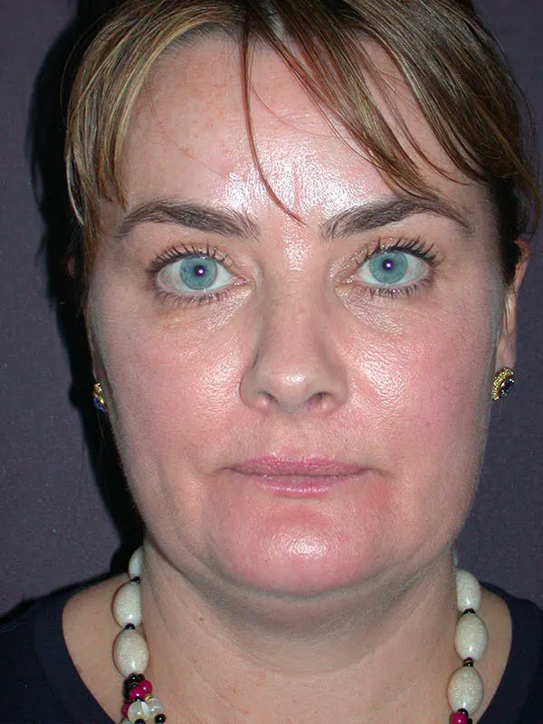 Neck Lift Before & After Gallery - Patient 40633466 - Image 3