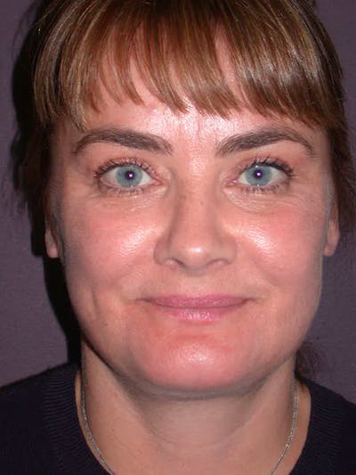 Neck Lift Before & After Gallery - Patient 40633466 - Image 4