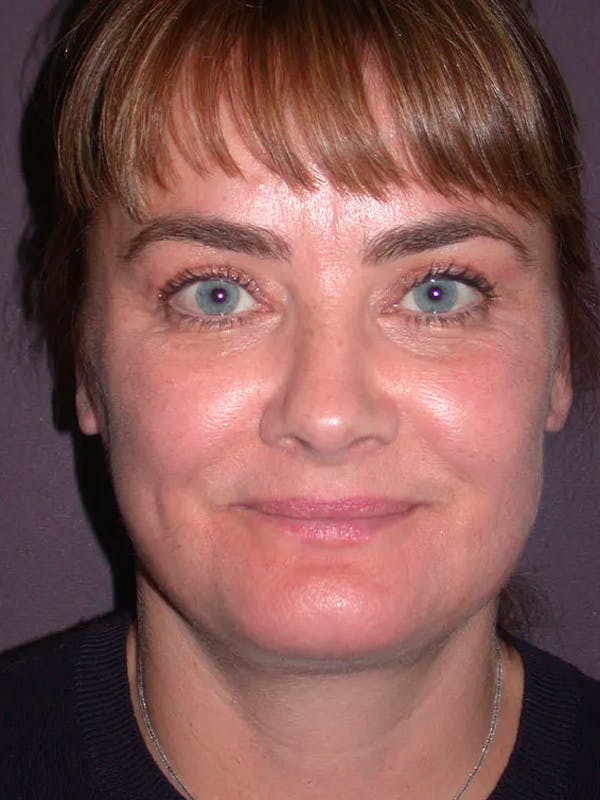 Neck Lift Before & After Gallery - Patient 40633466 - Image 4